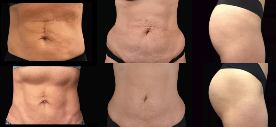 EMSculpt Neo before and after