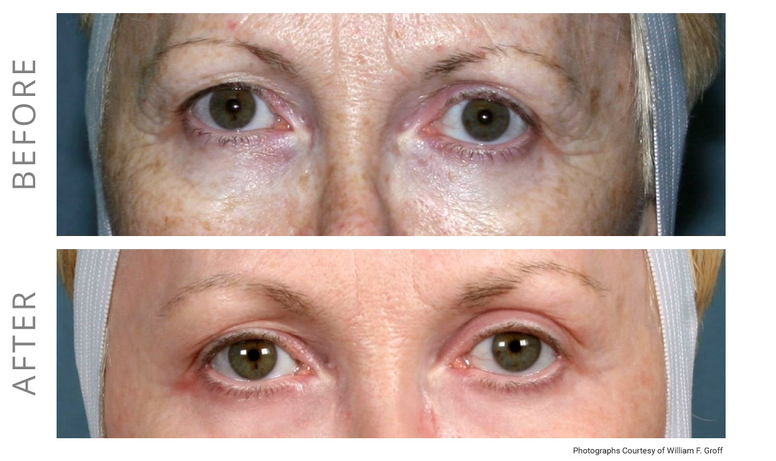 Eye Lift Results
