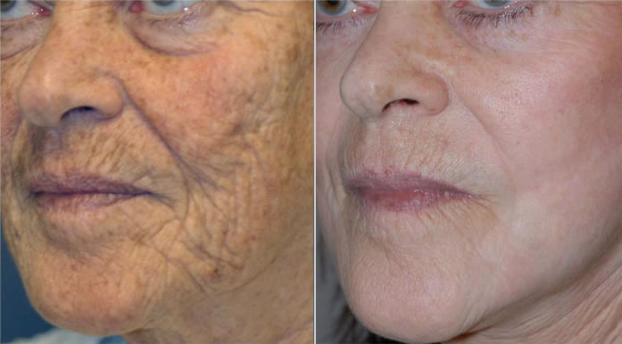 Face Lift Results