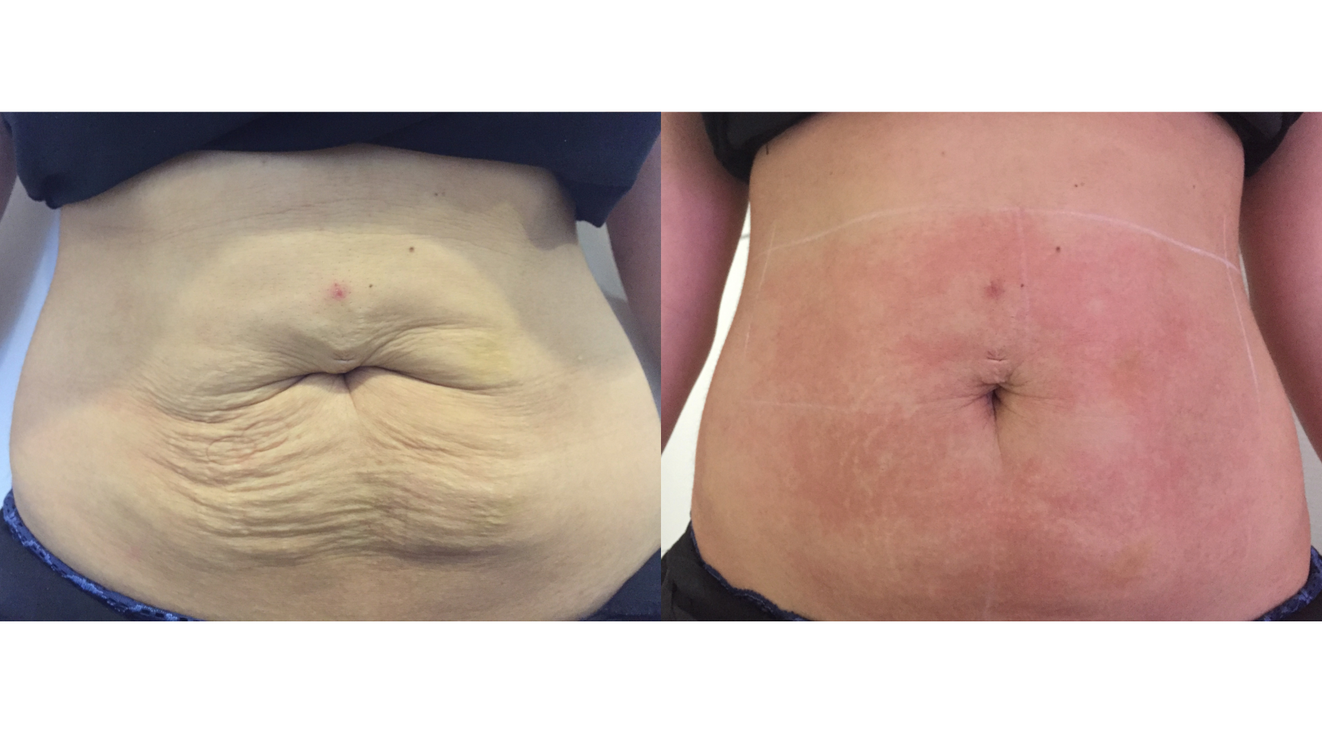Ultraformer III Before and After — EF MEDISPA Client