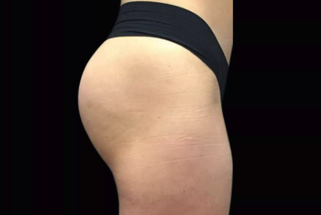 After Emsculpt NEO 1