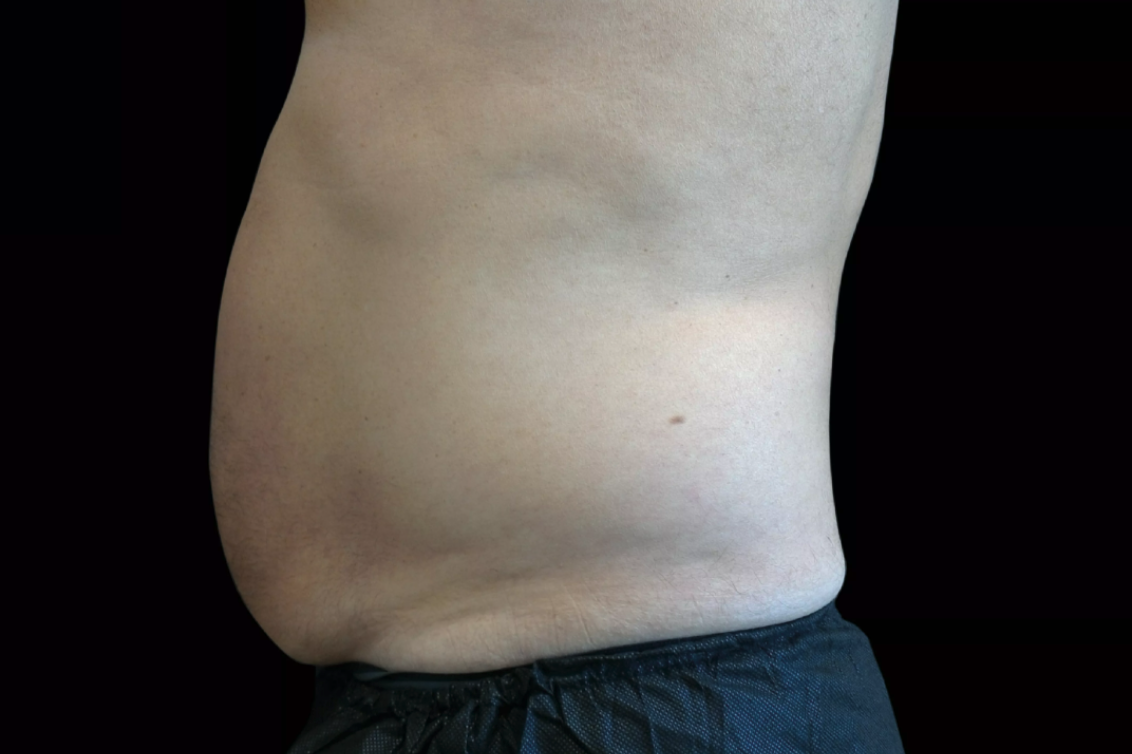 After Emsculpt NEO 2