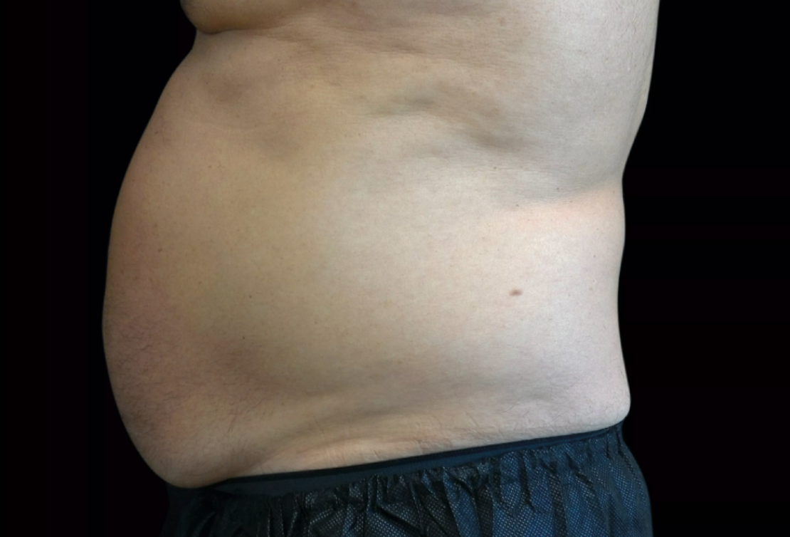 Before Emsculpt NEO 2