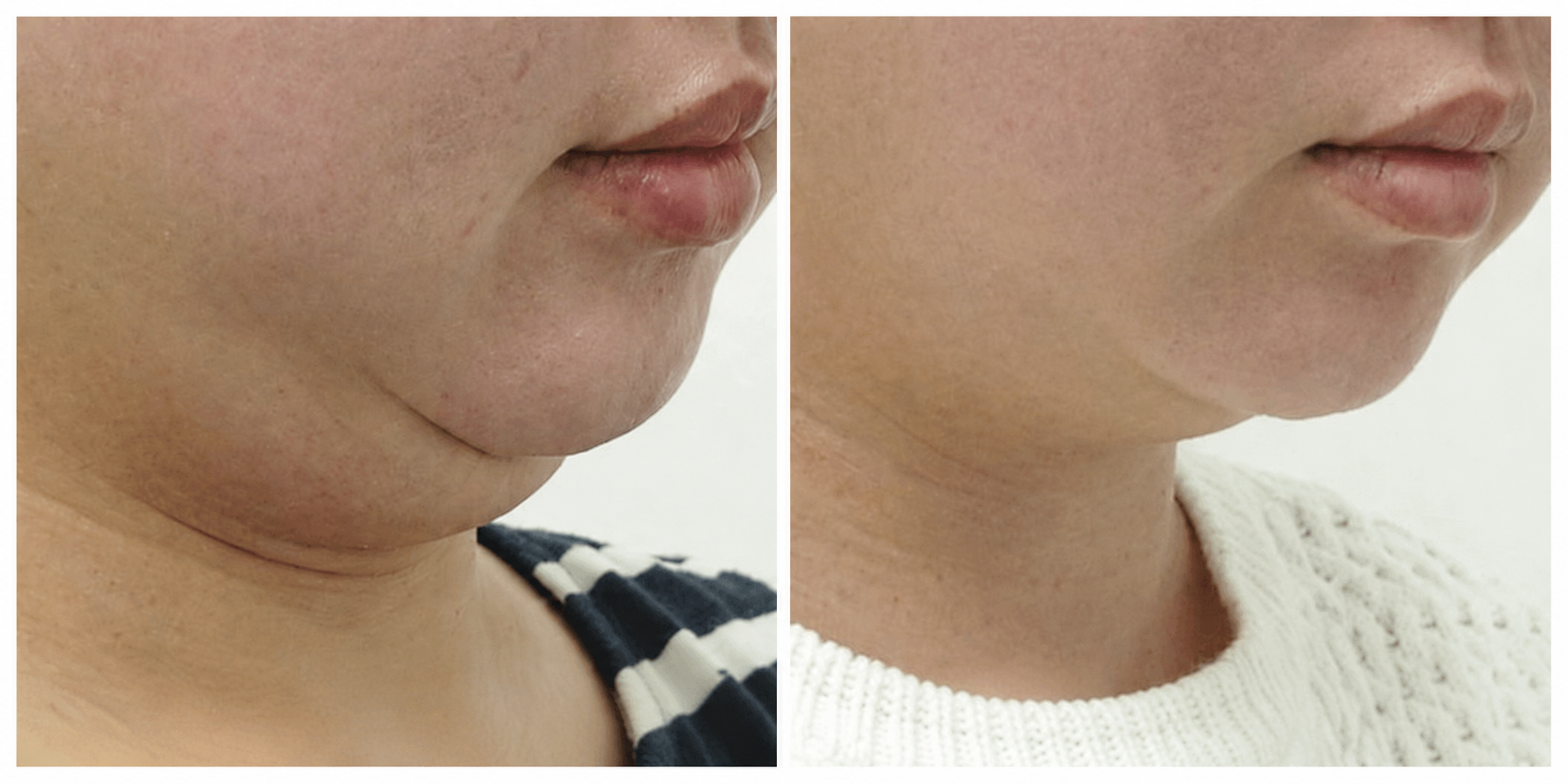 Clatuu fat freezing before and after